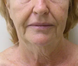 facelift before photo by michigan cosmetic surgery in southfield mi