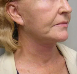 facelift after photo by michigan cosmetic surgery in southfield mi