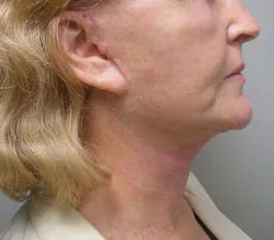 facelift after photo by michigan cosmetic surgery in southfield mi
