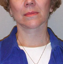 facelift after photo by michigan cosmetic surgery in southfield mi