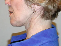 facelift after photo by michigan cosmetic surgery in southfield mi