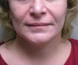 facelift after photo by michigan cosmetic surgery in southfield mi