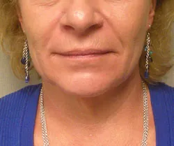 facelift before photo by michigan cosmetic surgery in southfield mi