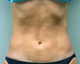 liposuction after photo by michigan cosmetic surgery in southfield mi