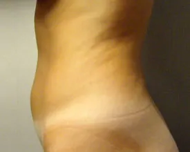 liposuction before photo by michigan cosmetic surgery in southfield mi