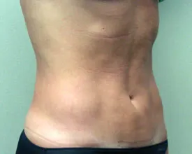 liposuction after photo by michigan cosmetic surgery in southfield mi
