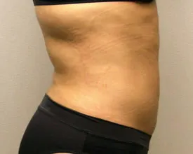 liposuction after photo by michigan cosmetic surgery in southfield mi