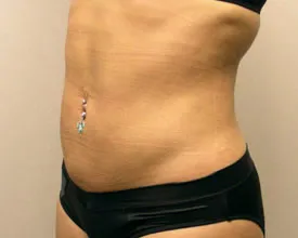 liposuction after photo by michigan cosmetic surgery in southfield mi