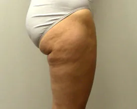 liposuction after photo by michigan cosmetic surgery in southfield mi