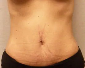 liposuction after photo by michigan cosmetic surgery in southfield mi