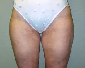 liposuction after photo by michigan cosmetic surgery in southfield mi