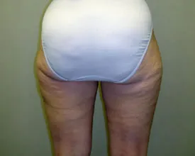 liposuction after photo by michigan cosmetic surgery in southfield mi
