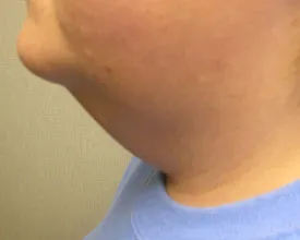 chin liposuction before photo by michigan cosmetic surgery in southfield mi