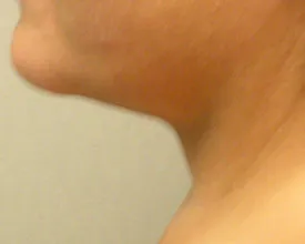 chin liposuction after photo by michigan cosmetic surgery in southfield mi