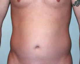 liposuction before photo by michigan cosmetic surgery in southfield mi