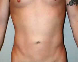 liposuction after photo by michigan cosmetic surgery in southfield mi