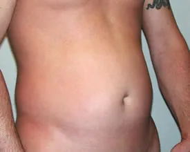 liposuction before photo by michigan cosmetic surgery in southfield mi