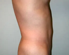 liposuction after photo by michigan cosmetic surgery in southfield mi