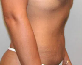 liposuction after photo by michigan cosmetic surgery in southfield mi