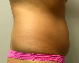 liposuction before photo by michigan cosmetic surgery in southfield mi