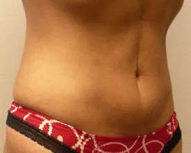 liposuction after photo by michigan cosmetic surgery in southfield mi