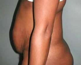 liposuction before photo by michigan cosmetic surgery in southfield mi