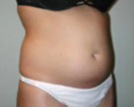 liposuction before photo by michigan cosmetic surgery in southfield mi