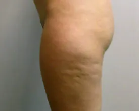 liposuction before photo by michigan cosmetic surgery in southfield mi