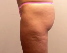 liposuction after photo by michigan cosmetic surgery in southfield mi