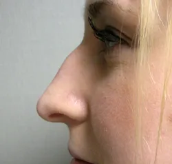 rhinoplasty before photo by michigan cosmetic surgery in southfield mi