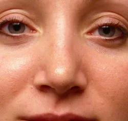rhinoplasty after photo by michigan cosmetic surgery in southfield mi