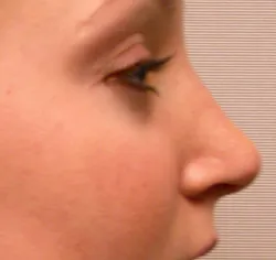rhinoplasty after photo by michigan cosmetic surgery in southfield mi