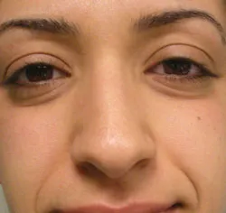 rhinoplasty before photo by michigan cosmetic surgery in southfield mi