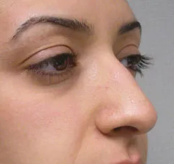 rhinoplasty before photo by michigan cosmetic surgery in southfield mi