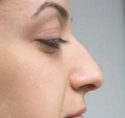 rhinoplasty before photo by michigan cosmetic surgery in southfield mi