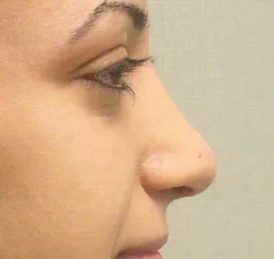 rhinoplasty after photo by michigan cosmetic surgery in southfield mi