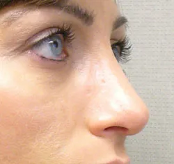 rhinoplasty after photo by michigan cosmetic surgery in southfield mi