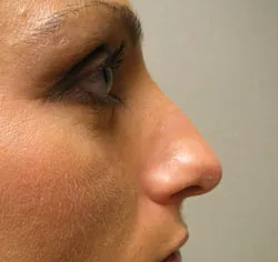 rhinoplasty before photo by michigan cosmetic surgery in southfield mi