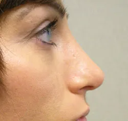 rhinoplasty after photo by michigan cosmetic surgery in southfield mi