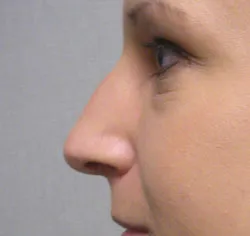 rhinoplasty before photo by michigan cosmetic surgery in southfield mi