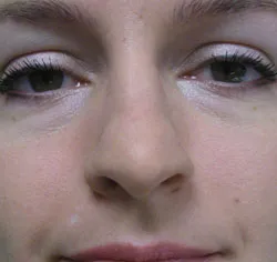 rhinoplasty before photo by michigan cosmetic surgery in southfield mi