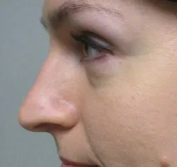 rhinoplasty before photo by michigan cosmetic surgery in southfield mi