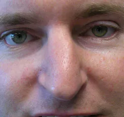 rhinoplasty before photo by michigan cosmetic surgery in southfield mi