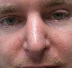 rhinoplasty after photo by michigan cosmetic surgery in southfield mi