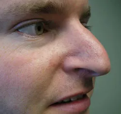 rhinoplasty before photo by michigan cosmetic surgery in southfield mi