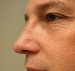rhinoplasty after photo by michigan cosmetic surgery in southfield mi