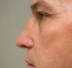 rhinoplasty after photo by michigan cosmetic surgery in southfield mi