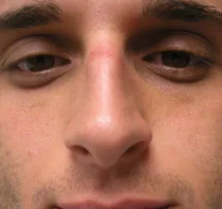 rhinoplasty before photo by michigan cosmetic surgery in southfield mi