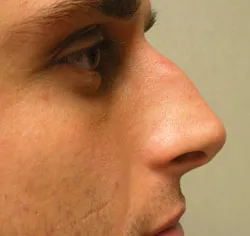 rhinoplasty before photo by michigan cosmetic surgery in southfield mi