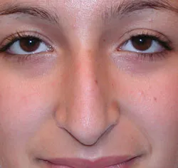 rhinoplasty before photo by michigan cosmetic surgery in southfield mi